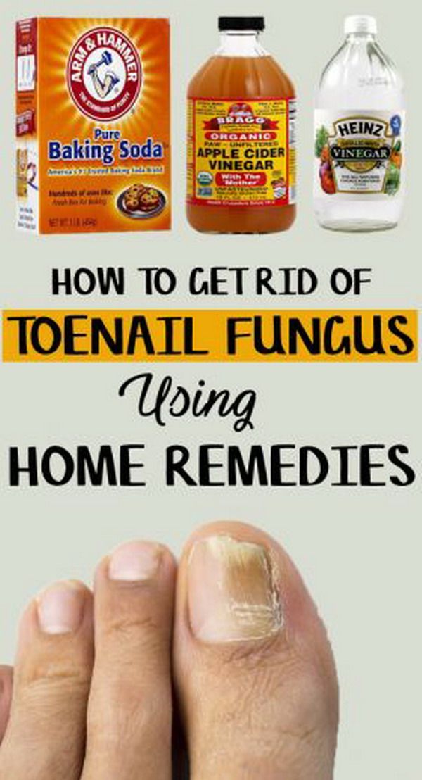How to Get Rid of Toenail Fungus â 9 Home Remedies ...