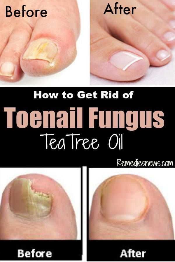 How to Get Rid of Toenail Fungus, before and after, with Tea Tree Oil ...