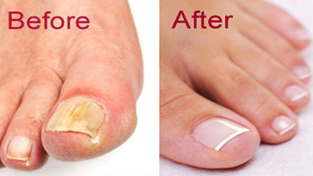 How to Get Rid of Toenail Fungus Fast and Naturally