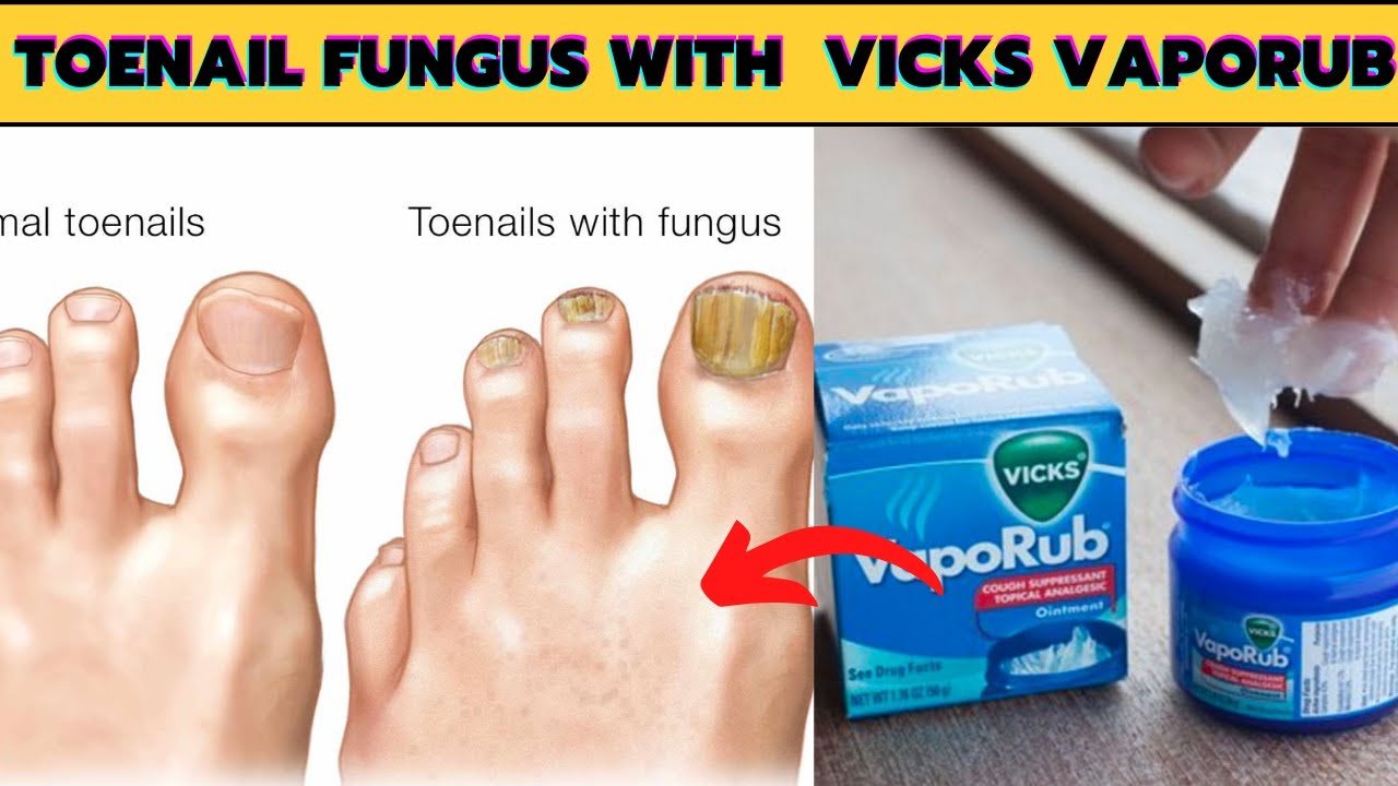 How to get rid of toenail fungus fast and naturally with bleach and ...