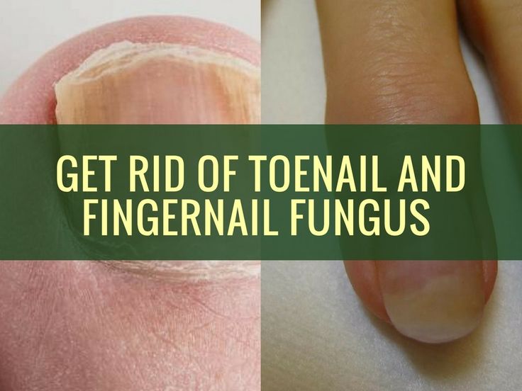 How to get rid of toenail fungus fast and naturally with ...