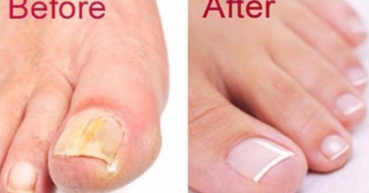 How to Get Rid of Toenail Fungus Fast and Naturally ...