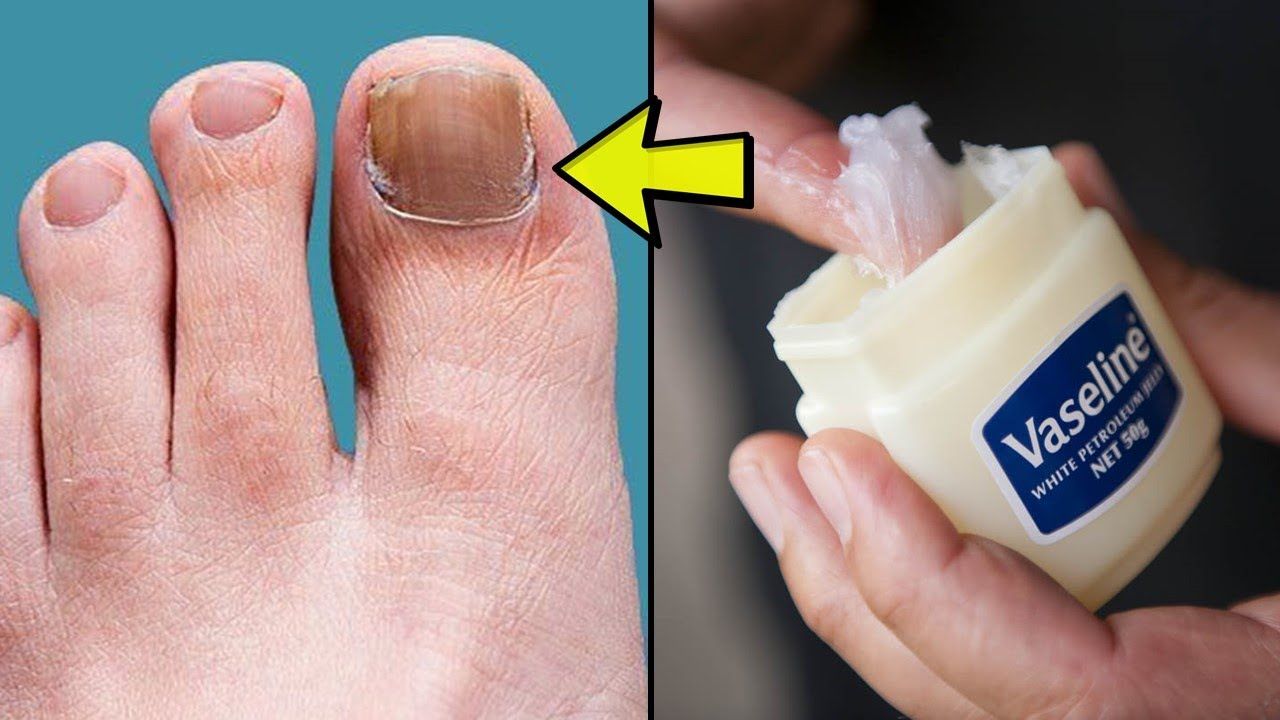 How to Get Rid of Toenail Fungus Fast at Home