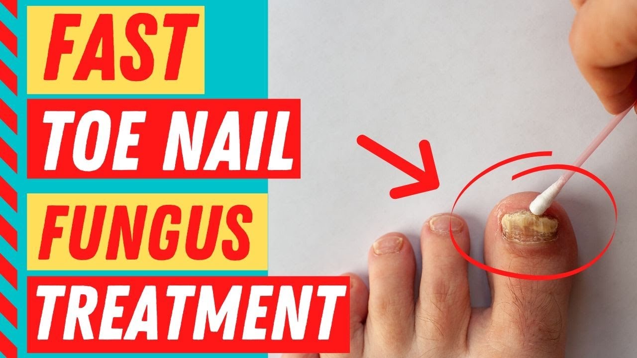 How To Get Rid Of Toenail Fungus Fast