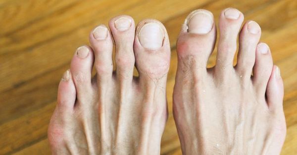 How to Get Rid of Toenail Fungus Fast
