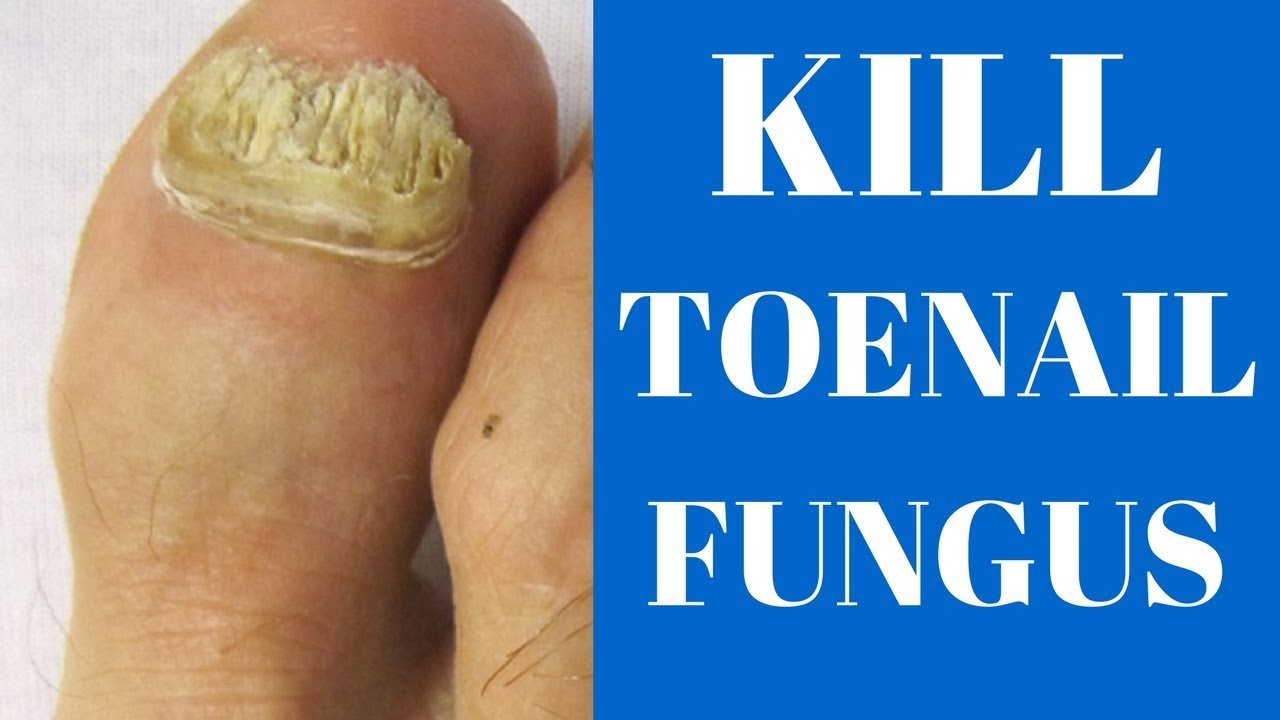 How to get rid of toenail fungus fast!! (Here