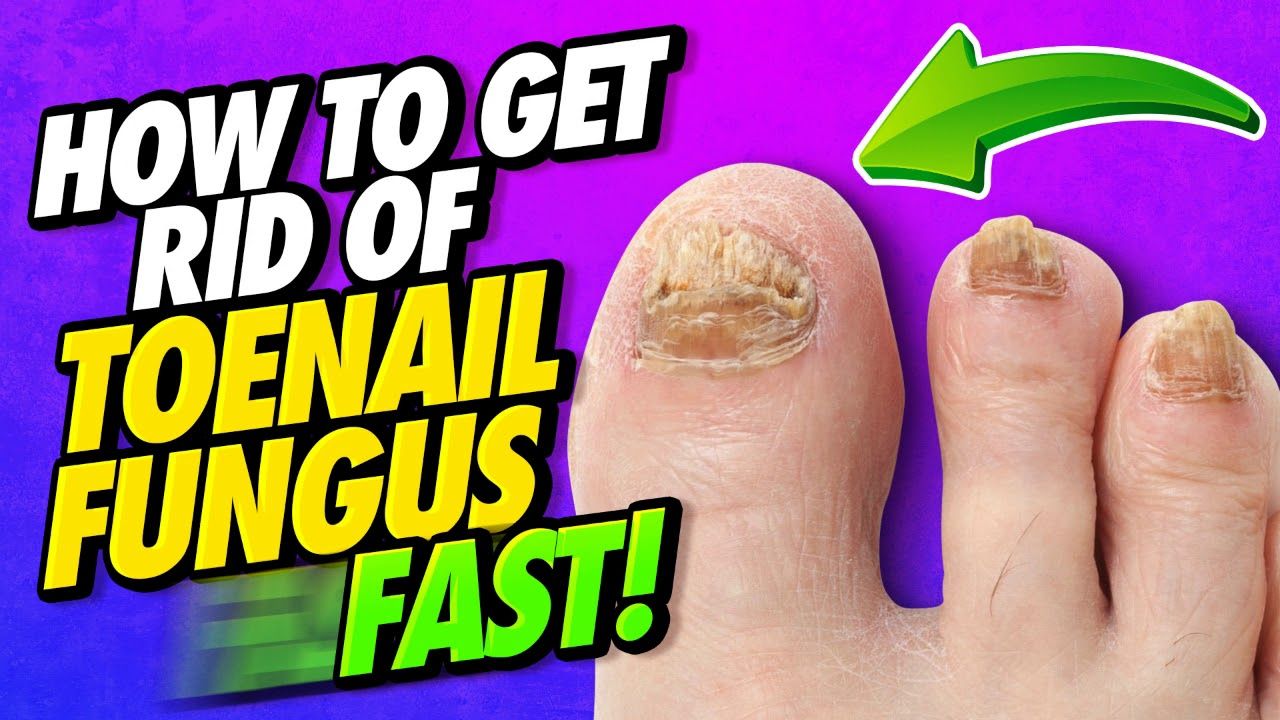 How To Get Rid of Toenail Fungus Fast!!! in 2021