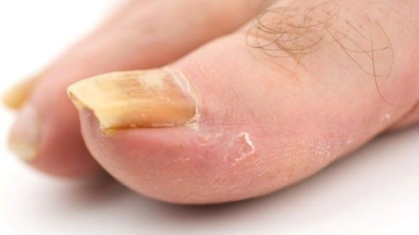 How to Get Rid of Toenail Fungus Fast &  Naturally ...