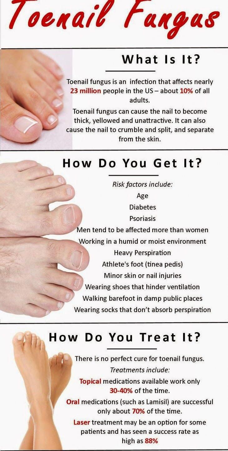 How to Get Rid of Toenail Fungus #FrenchTipAcrylicNails