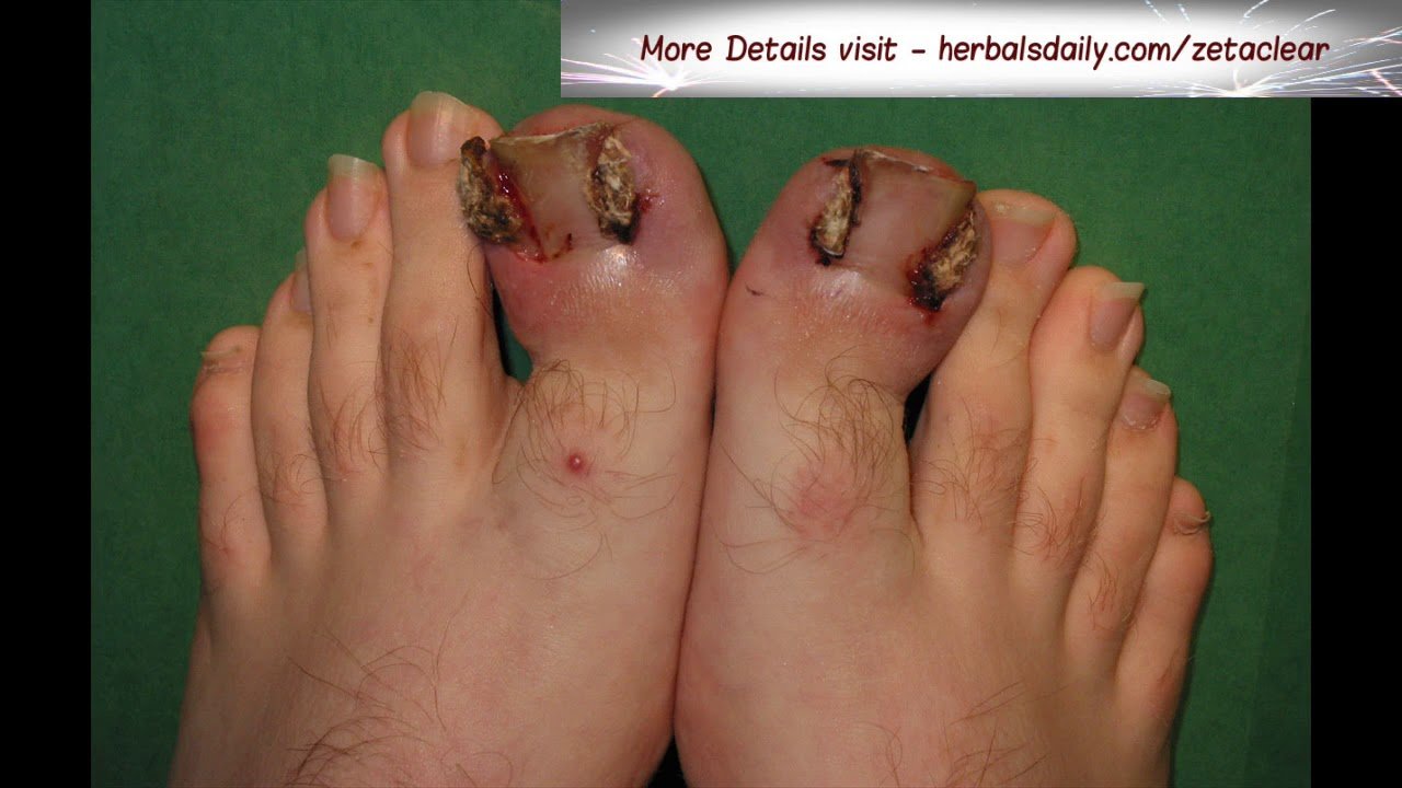 How To Get Rid Of Toenail Fungus Home Remedies