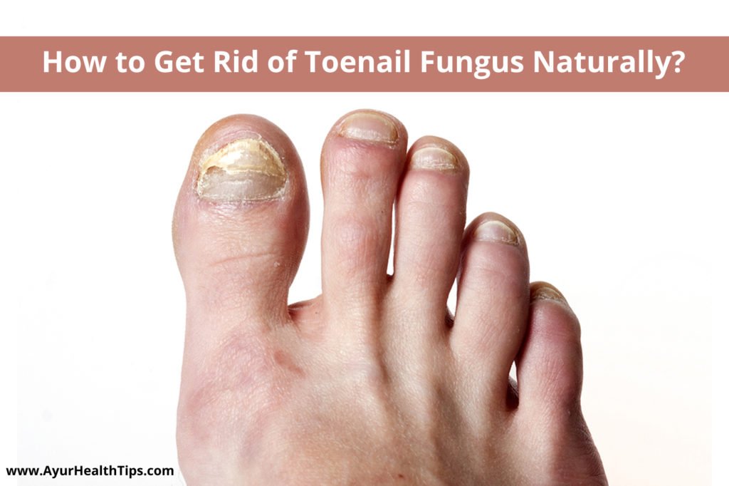 How To Get Rid Of Toenail Fungus Naturally