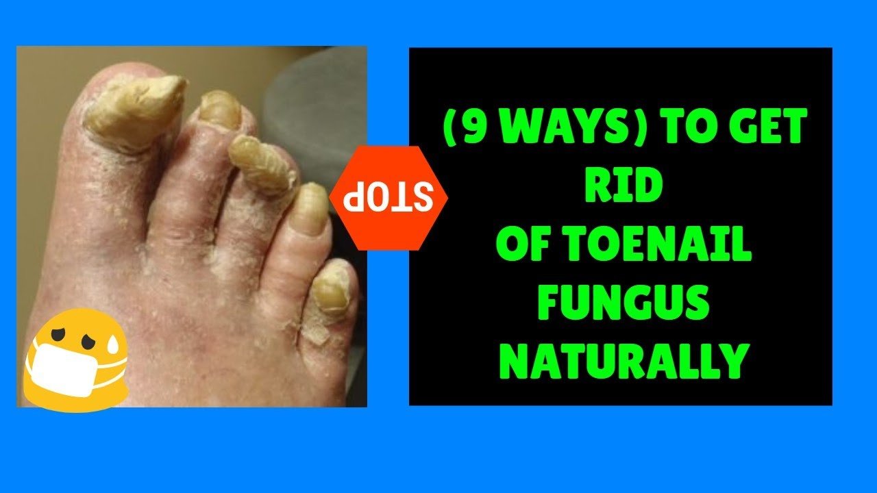 How To Get Rid of Toenail Fungus Naturally