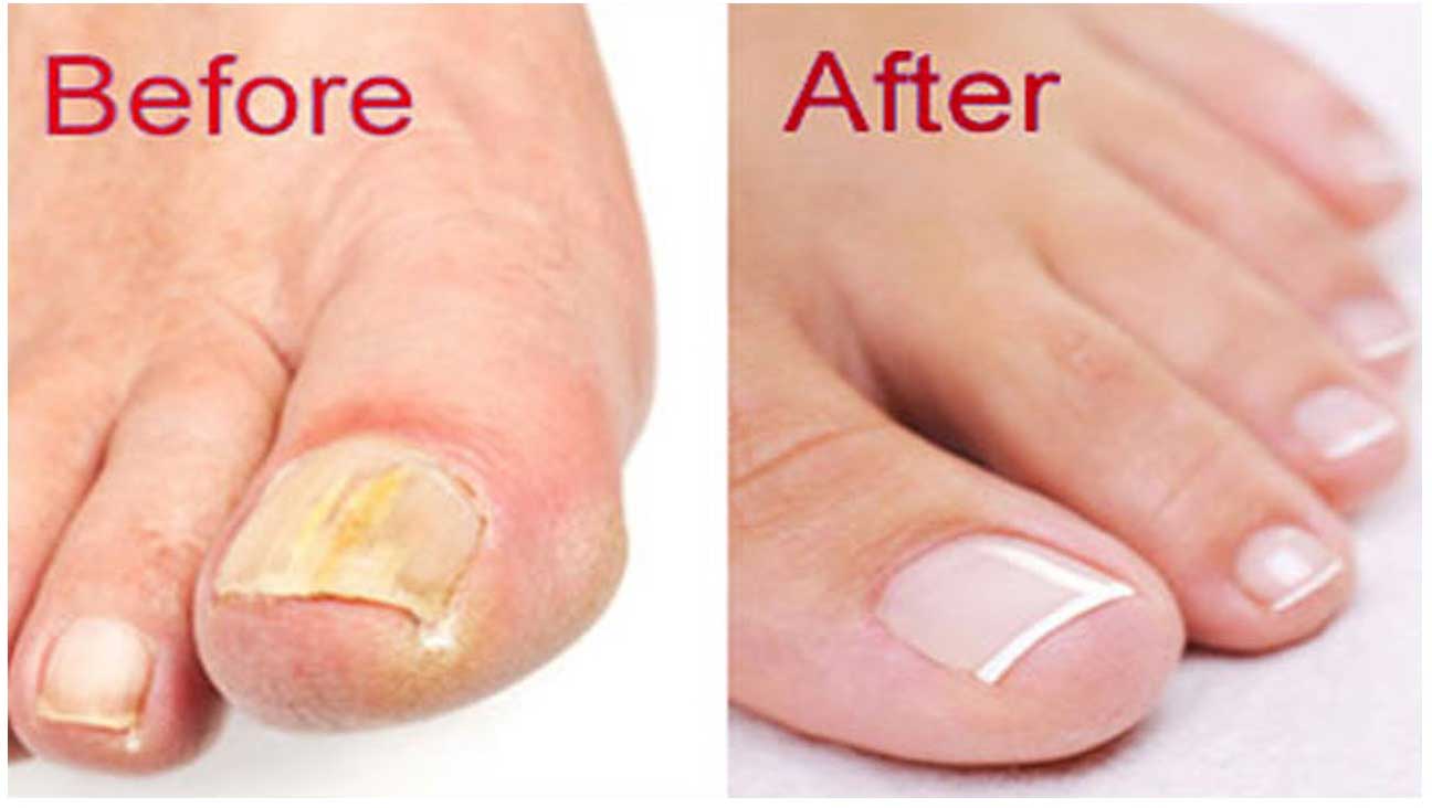 How To Get Rid Of Toenail Fungus Naturally With 5 Proven Remedies