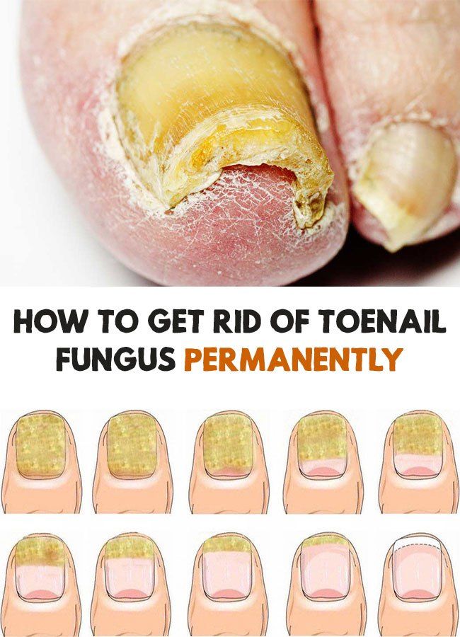 How to Get Rid of Toenail Fungus Permanently http://bit.ly/2SHbo8l The ...