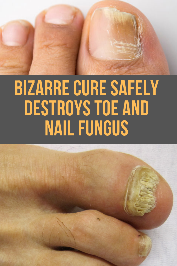 how to get rid of toenail fungus quick