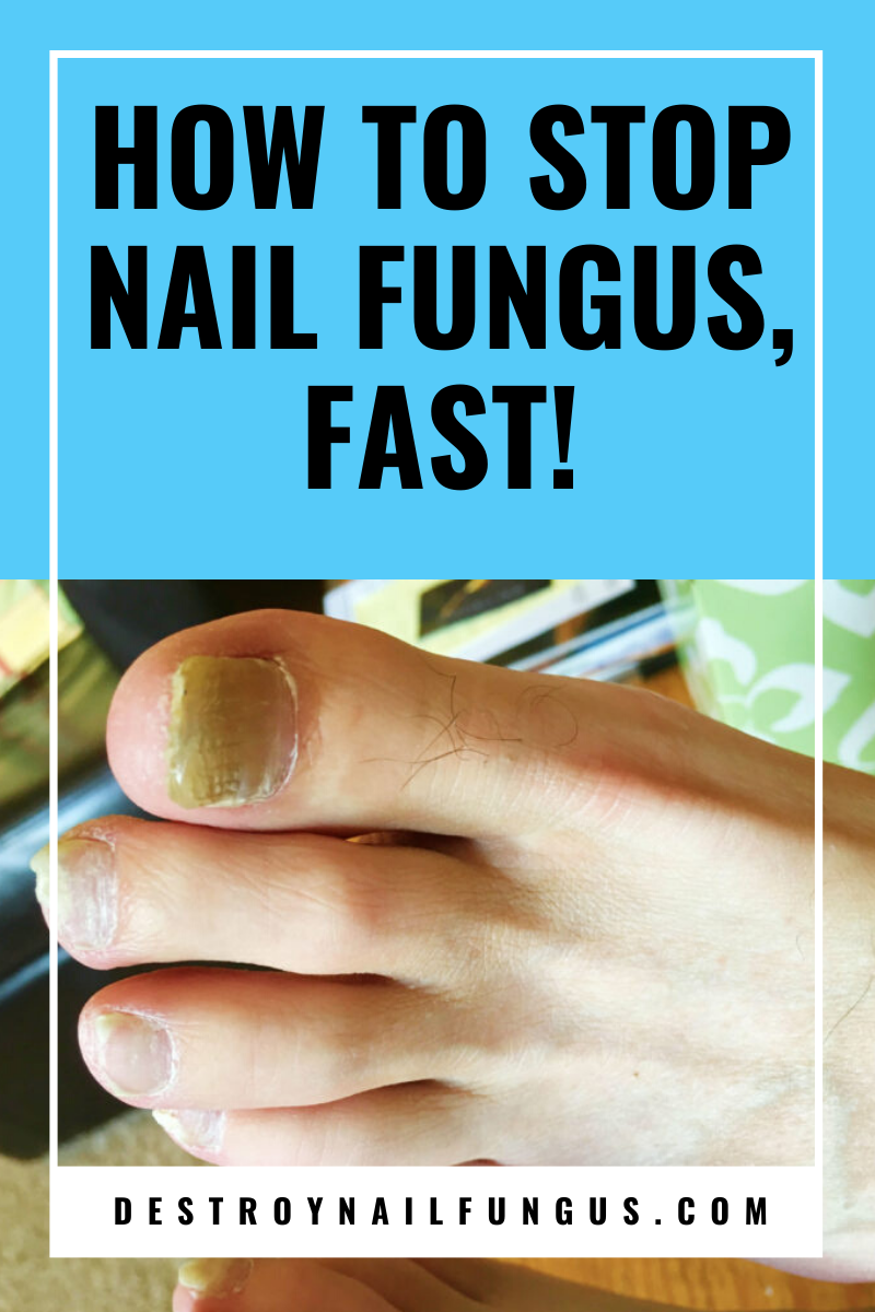 How To Get Rid Of Toenail Fungus Quickly (What You Need To Know) in ...
