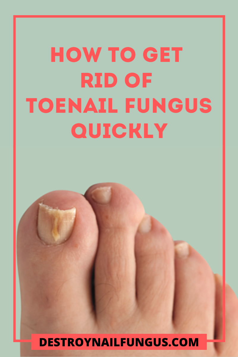 How To Get Rid Of Toenail Fungus Quickly (What You Need To ...