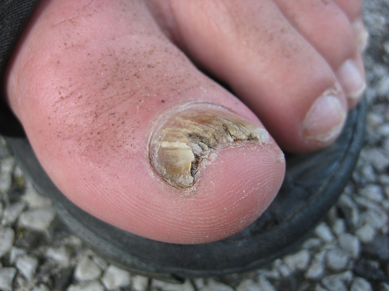 How to Get Rid of Toenail Fungus With Bleach? 2 Easy Ways