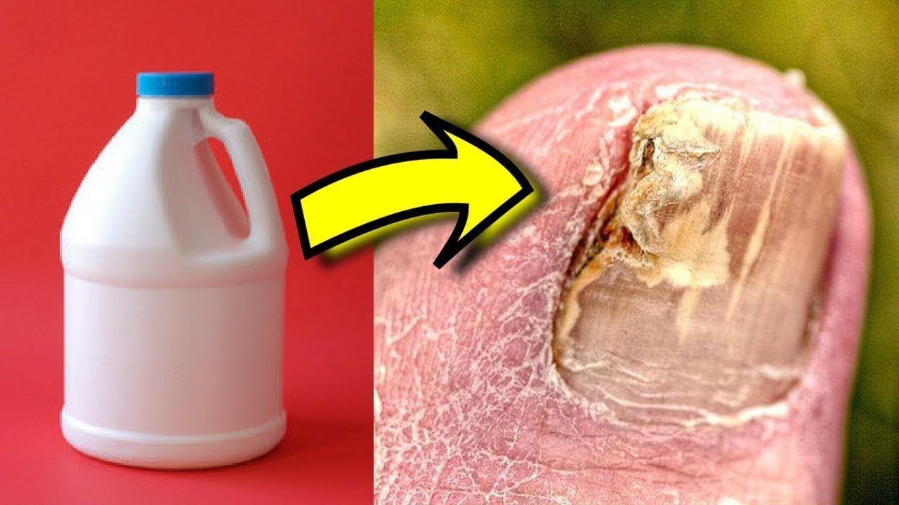 How to get rid of toenail fungus with bleach at home â An ...