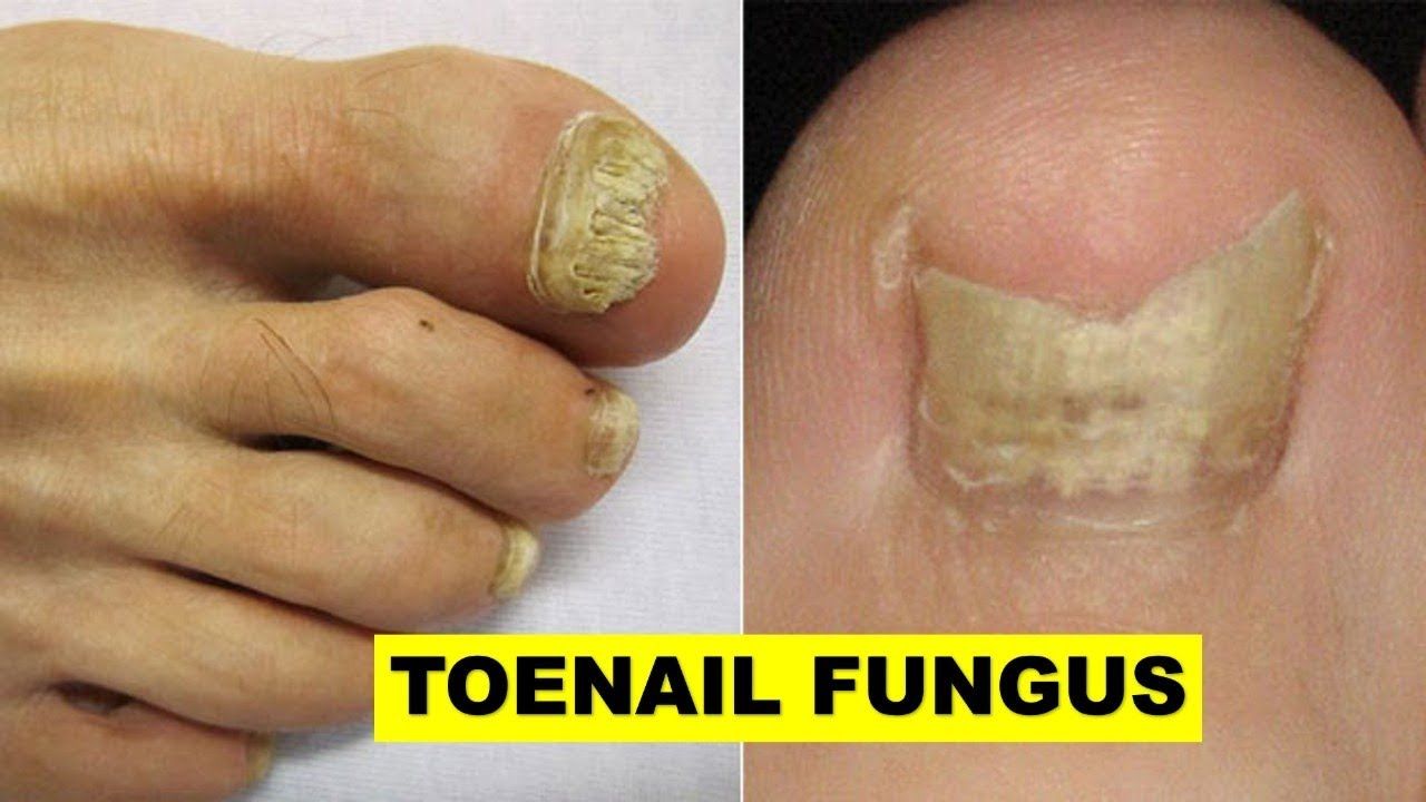 How to get rid of toenail fungus with bleach at home  An eaffective ...
