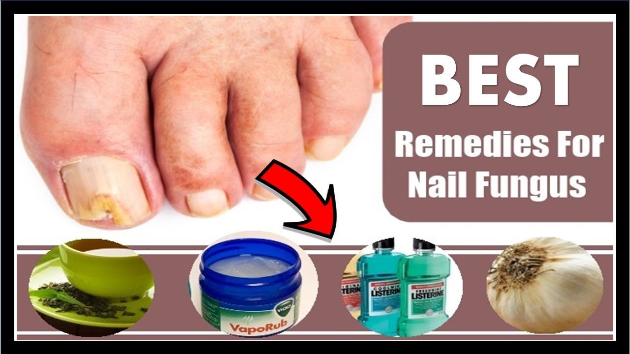 How To Get Rid Of Toenail Fungus With Bleach At Home  Get ...