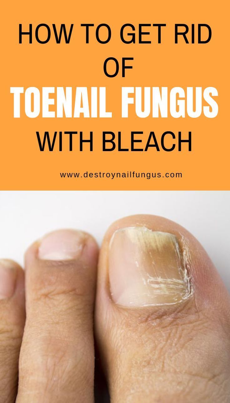 How to get rid of toenail fungus with bleach #bleach #less gets toenail ...