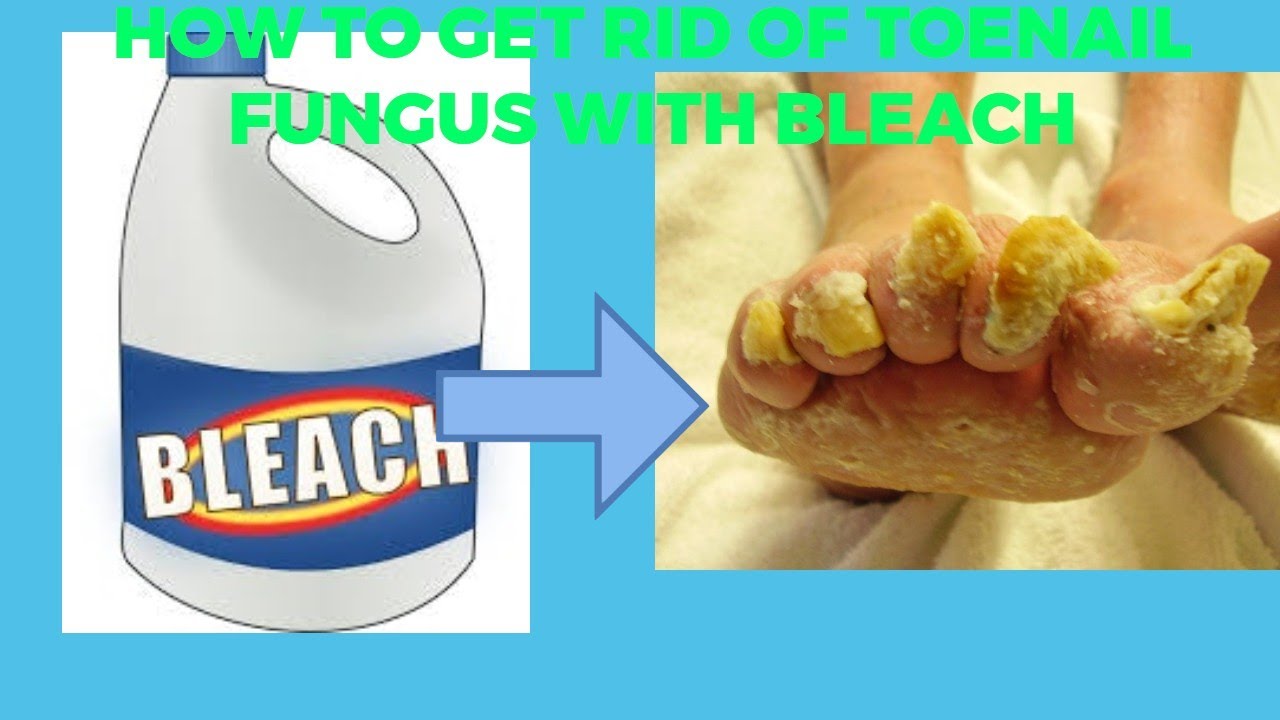 how to get rid of toenail fungus with bleach