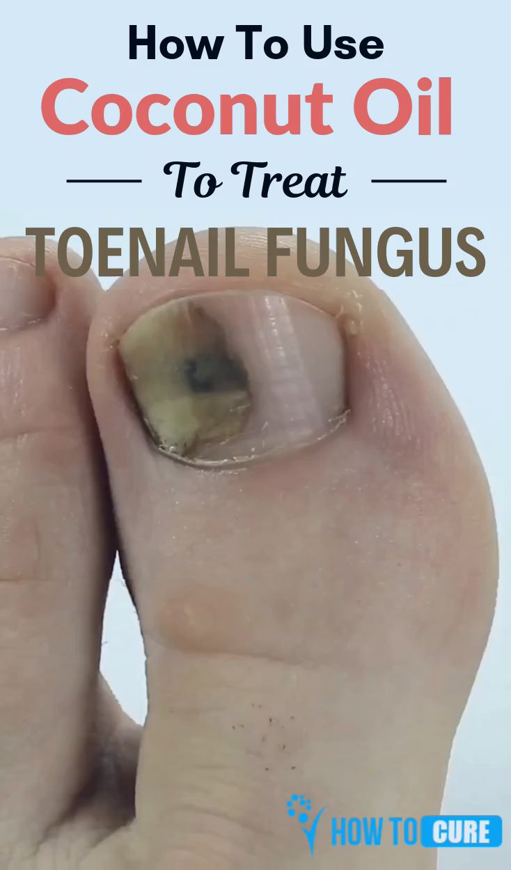 How To Get Rid Of Toenail Fungus With Coconut Oil ...