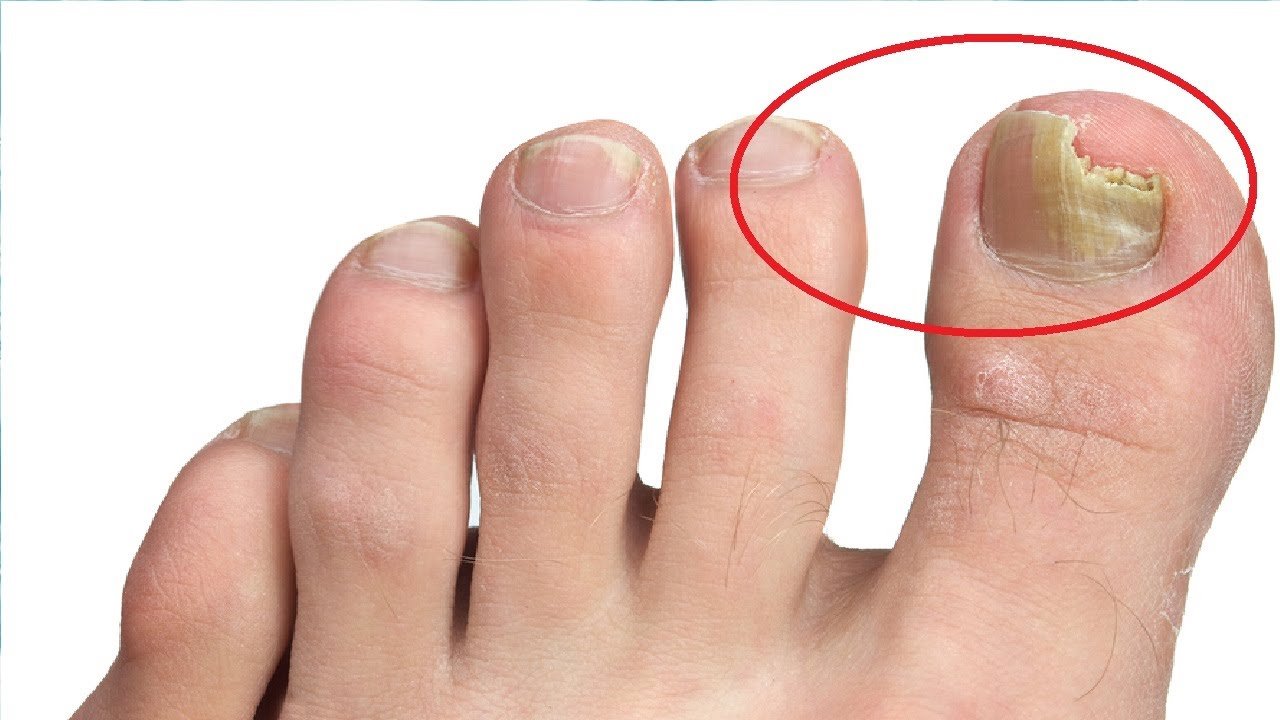 how to get rid of toenail fungus with epsom salt