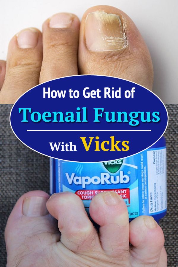 How to Get Rid of Toenail Fungus With Vicks