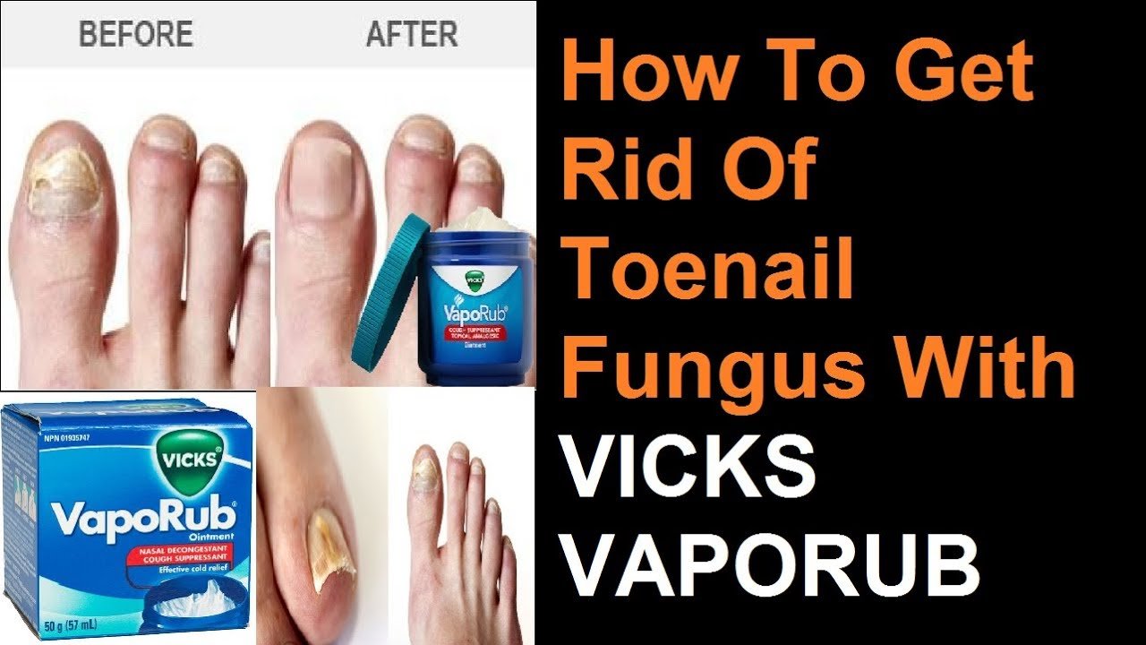 How To Get Rid Of Toenail Fungus With VICKS VAPORUB ...