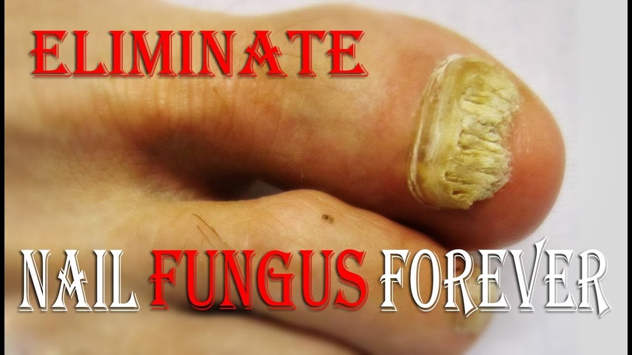 How To Get Rid Of Toenail Fungus Without Medication