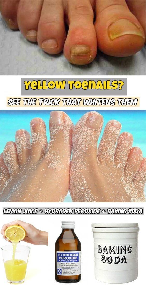 How To Get Rid Of Yellow Toenails