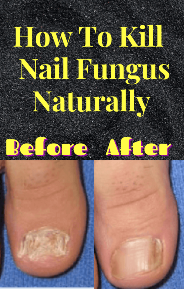 How To Kill Nail Fungus Naturally And Effectively