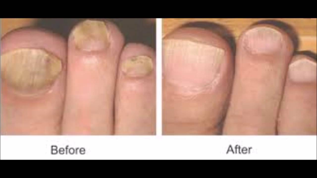 How To Know If Japanese Toenail Fungus