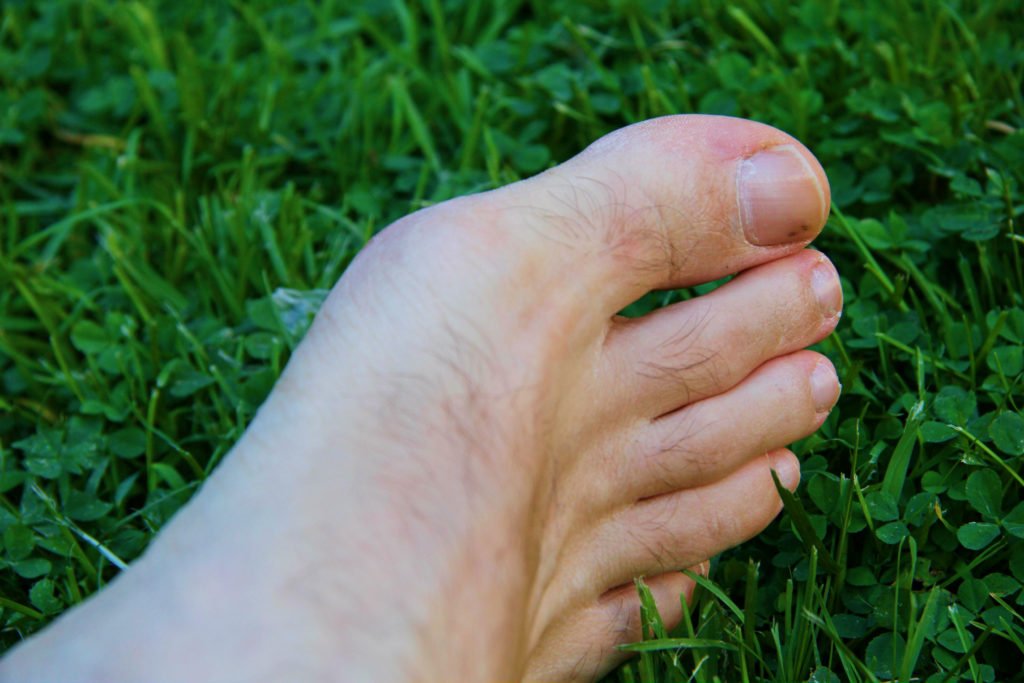 How To Know If Toenail Fungus Is Dying