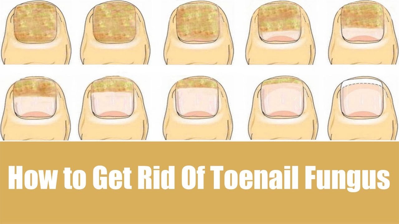How To Naturally Get Rid Of Toenail Fungus Fast