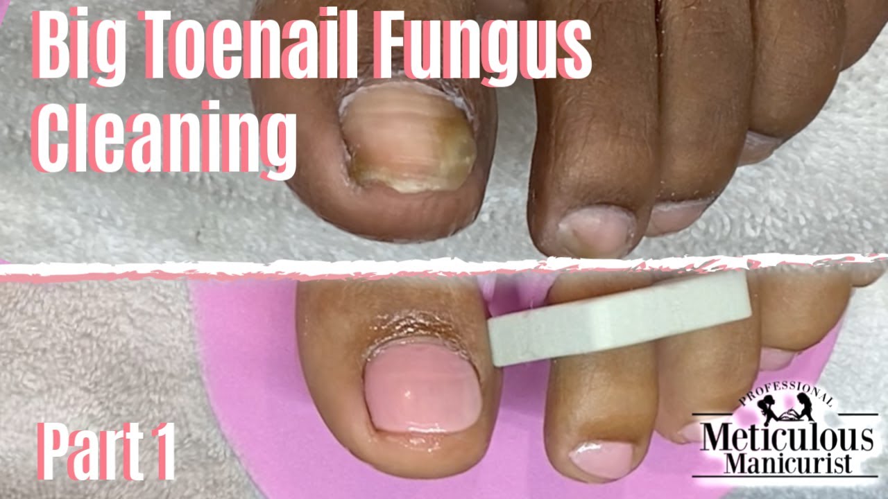 How To Pedicure Toenail Fungus Home Remedy Cleaning Part ...