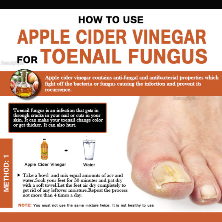 How to Prepare an Apple Cider Vinegar for Toenail Fungus? â Toussil