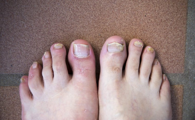 How to Prevent Toenail Fungus: 4 Helpful and Surprising Tips