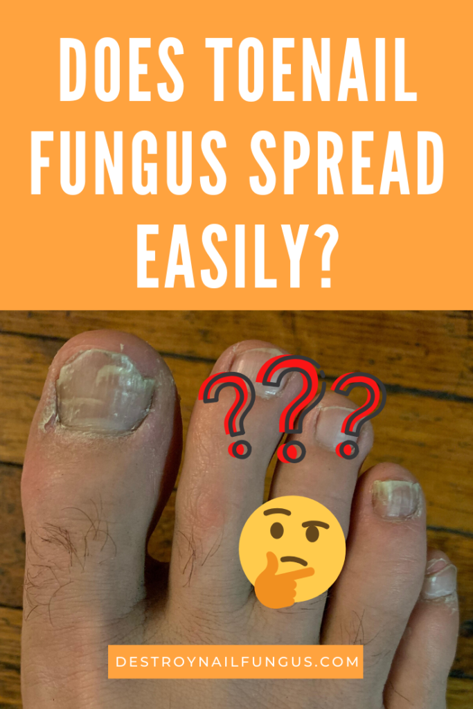 How to Prevent Toenail Fungus from Spreading to Your Family