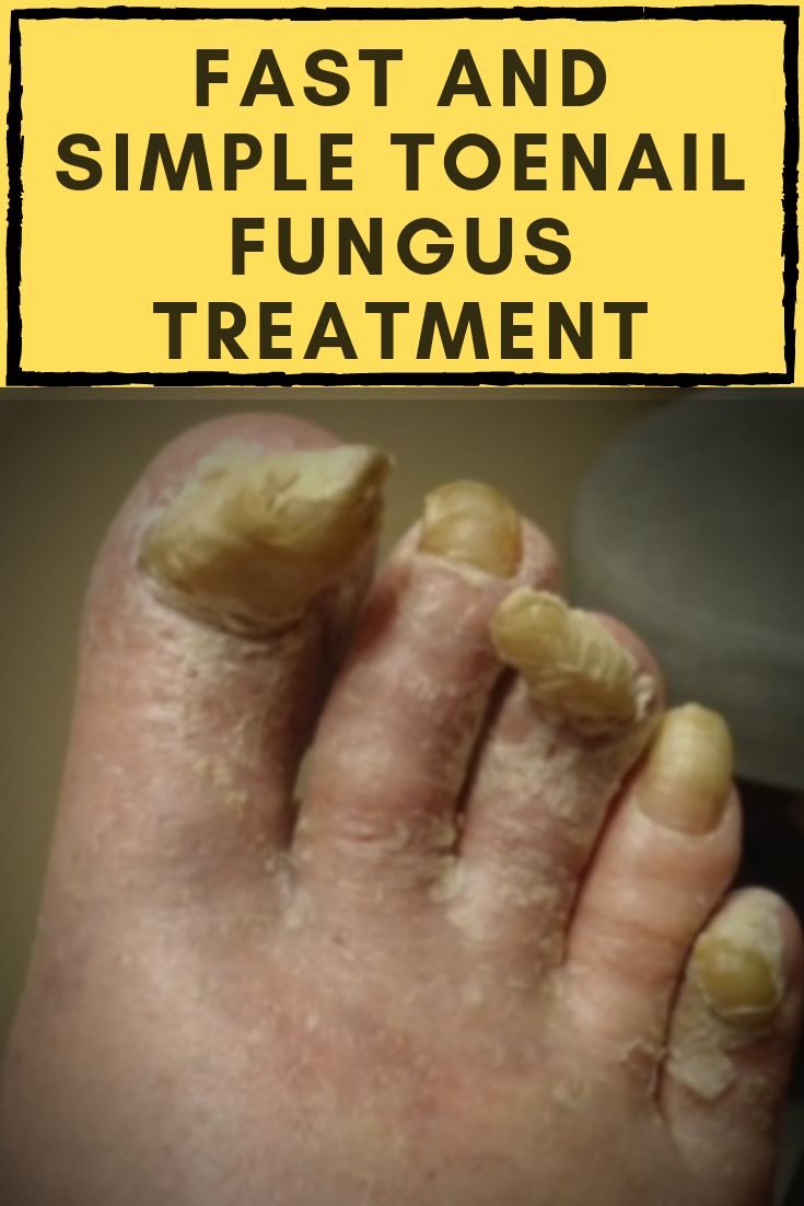 How To Remove Foot Fungus
