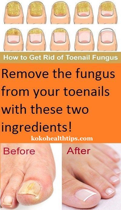 How To Remove Fungus From Your Toenails With These Best 2 ...