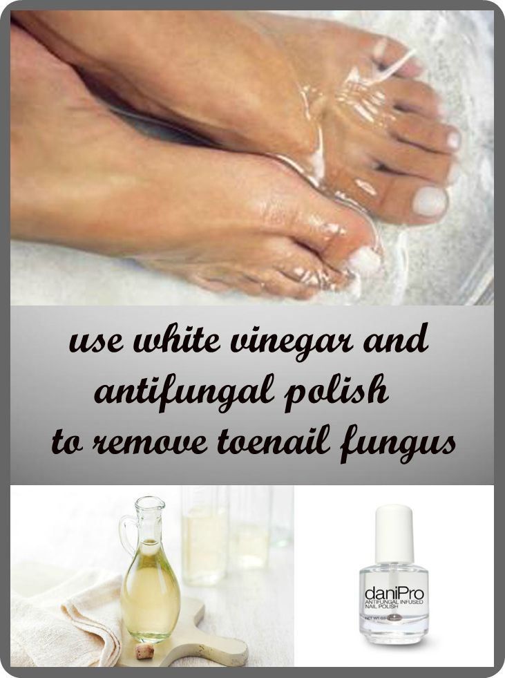 How to remove toenail fungus