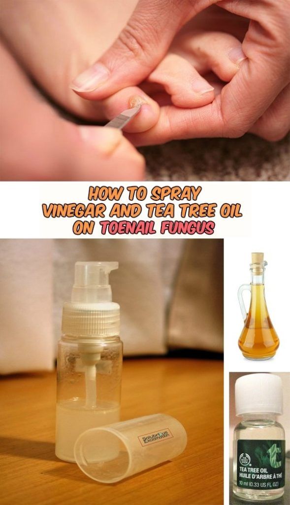How to spray vinegar and tea tree oil on toenail fungus ...