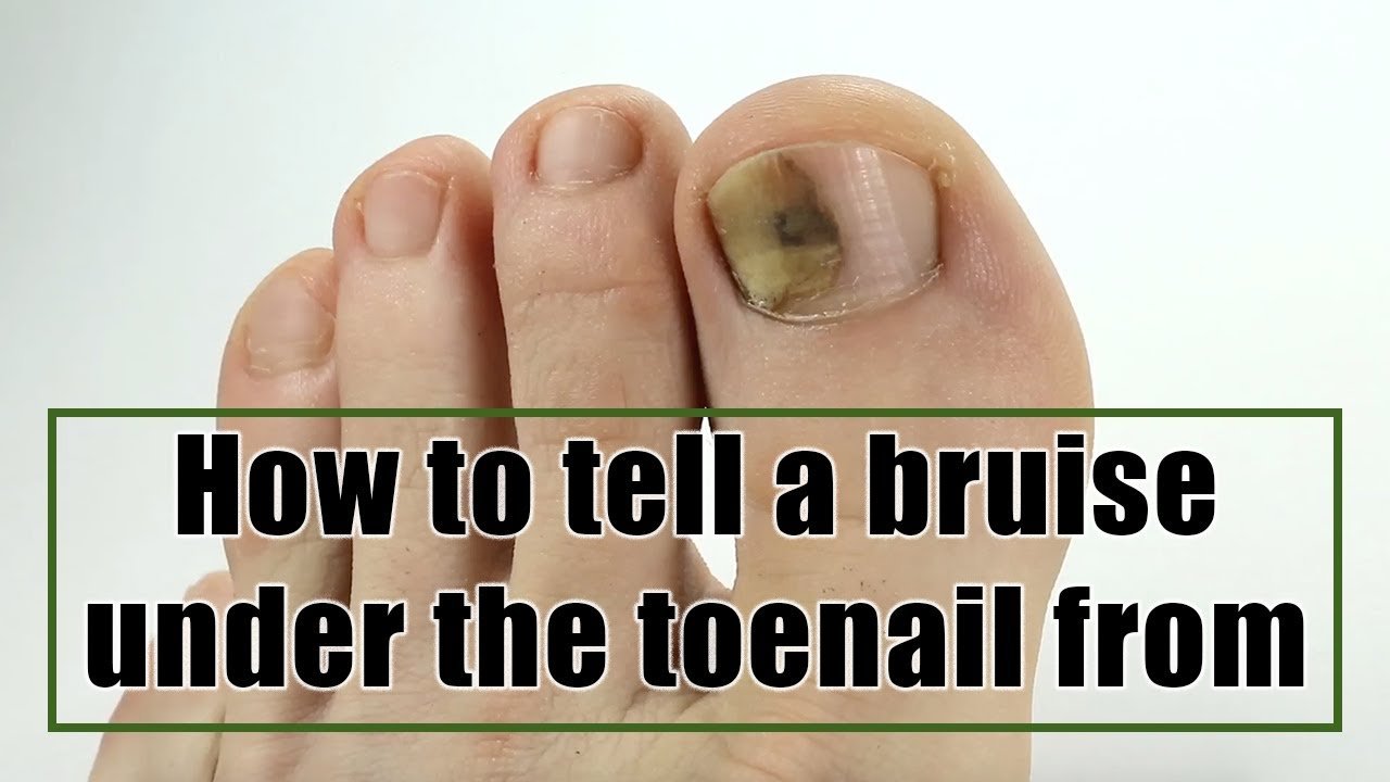 How to tell a bruise under the toenail from toenail fungus ...