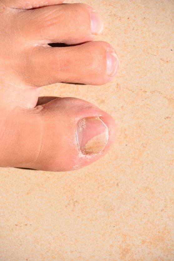 How to Tell if You Have a Toenail Fungus