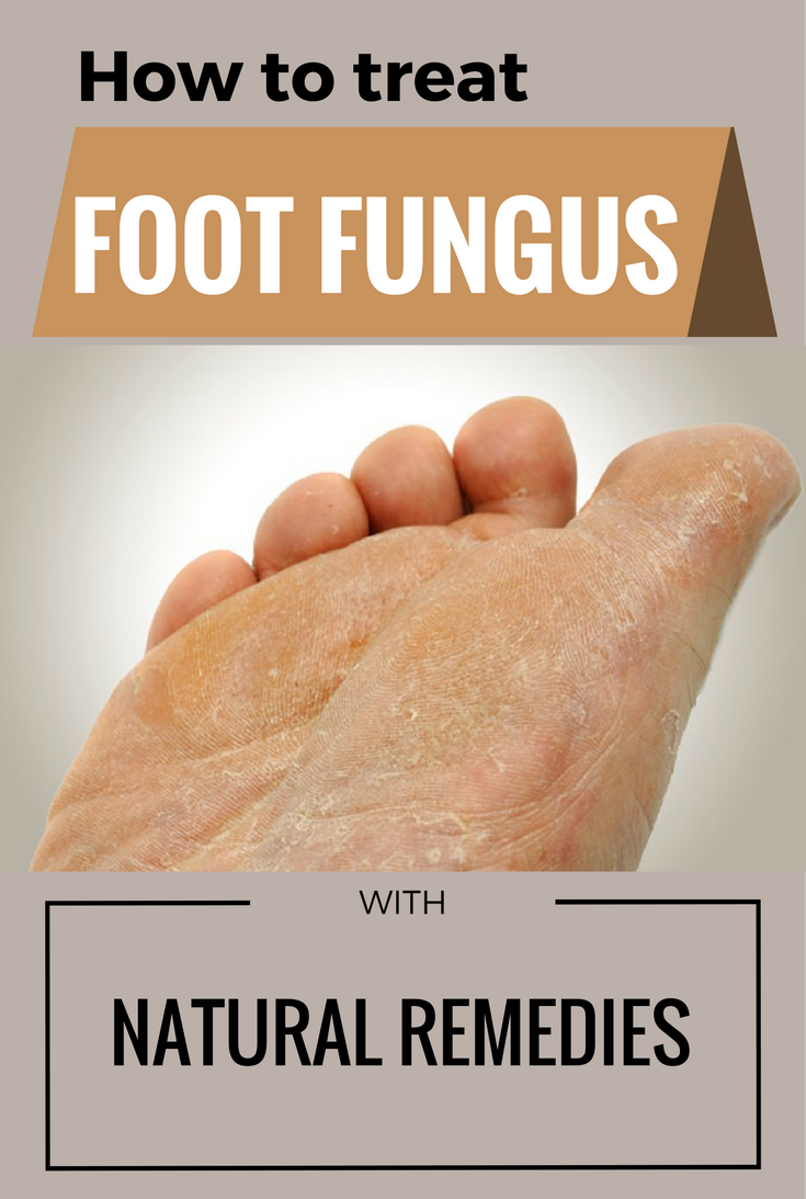 How To Treat Foot Fungus With Natural Remedies