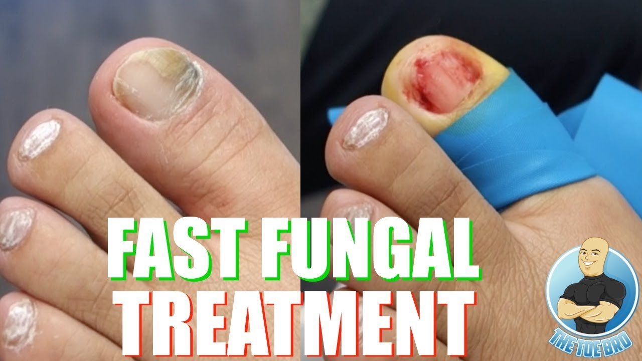 How To Treat Fungal Infection In Nails