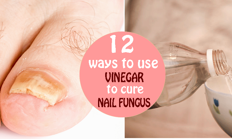 How to treat nail fungus with vinegar  12 natural ways ...